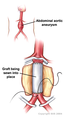 Vascular surgery